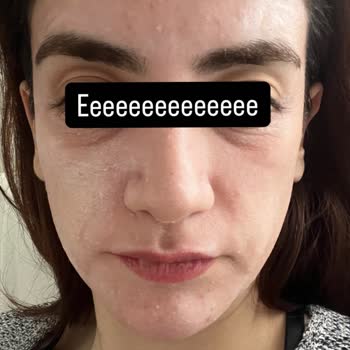 Altın İğne Uygulaması Sonrası Mağduriyet