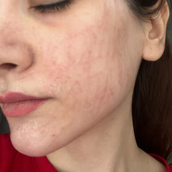 Altın İğne Uygulaması Sonrası Mağduriyet