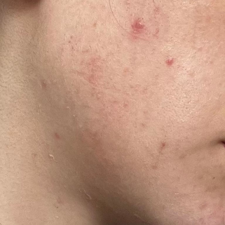 Altın İğne Uygulaması Sonrası Mağduriyet