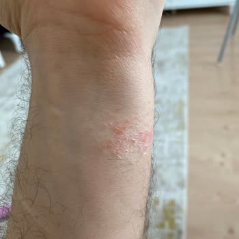 Xiaomi Watch 5 Lite: Alerji Ve Rahatsızlık Sorunu