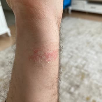 Xiaomi Watch 5 Lite: Alerji Ve Rahatsızlık Sorunu