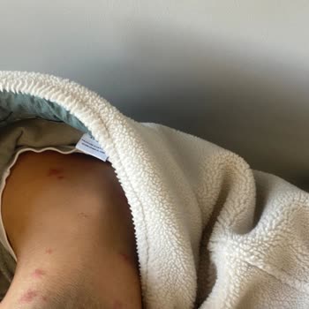 Hastanede Böcek Sorunu Ve Sağlık Tehlikesi