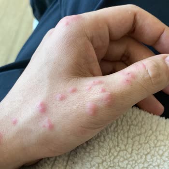 Hastanede Böcek Sorunu Ve Sağlık Tehlikesi