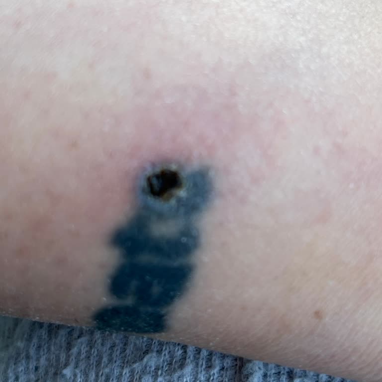 Lazer Yanığı Ve İade Sorunu