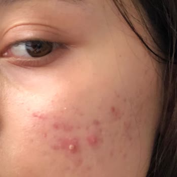 Bioderma Atoderm увлажнитель вызвал высыпания