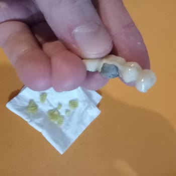 Lays Fırından Cips Dişimi Kırdı, Sağlık Riski Taşıyor!