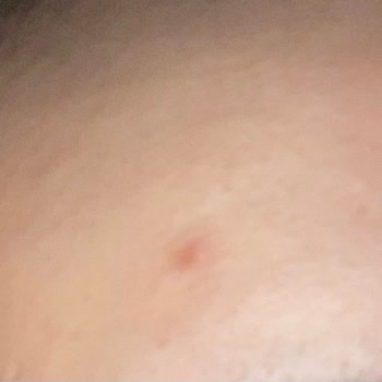 Yves Rocher Ürünleri Cildimde Ağrılı Sivilcelere Neden Oldu