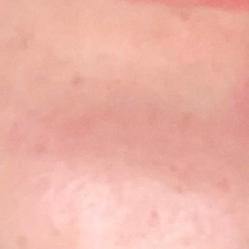 Yves Rocher Ürünleri Cildimde Ağrılı Sivilcelere Neden Oldu