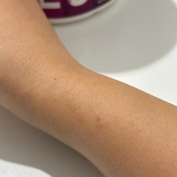 Ürün Kullanımı Sonrası Ciddi Alerjik Reaksiyon