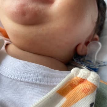 Islak Mendil Kullanımı Sonrası Cilt Sorunları