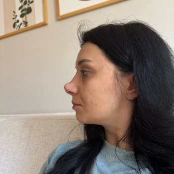 Burun Ameliyatında Estetik Ve Sağlık Sorunları