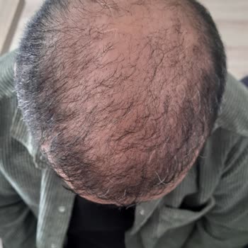 Gold City Saç Ekiminde Hayal Kırıklığı