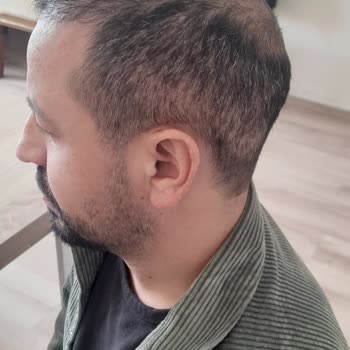 Gold City Saç Ekiminde Hayal Kırıklığı