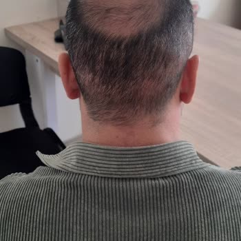 Gold City Saç Ekiminde Hayal Kırıklığı