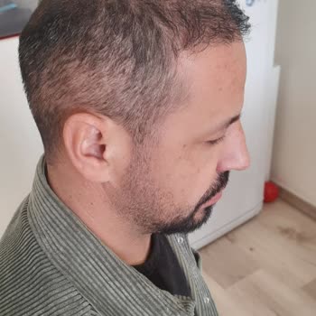 Gold City Saç Ekiminde Hayal Kırıklığı