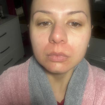 Ciltte Yanma Ve Kızarıklık Yapan Ürünler