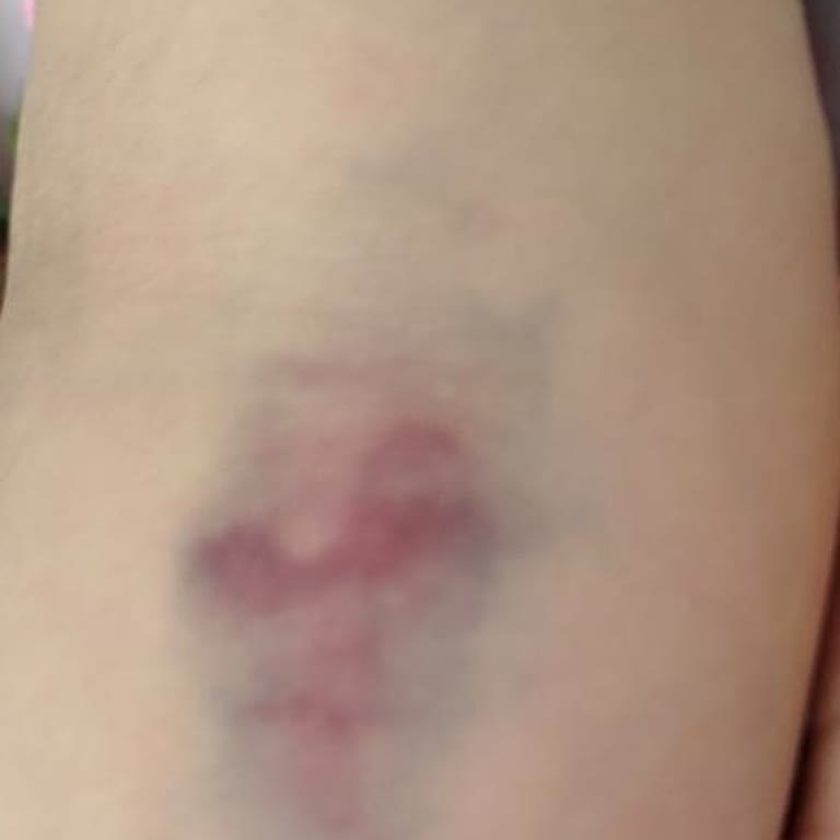 Kan Alma İşleminde Yaşanan Sorun Ve Hemşirelerin Nazik Olması Gerekliliği