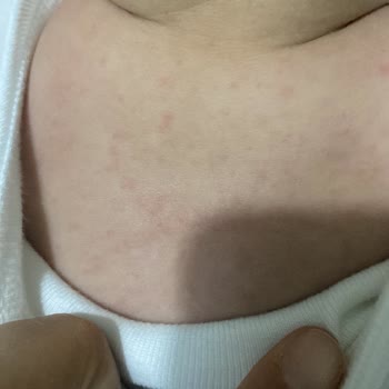 Bebeğime Uygulanan Yetersiz Tedavi Ve Yüksek Ücret