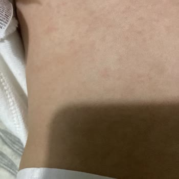 Bebeğime Uygulanan Yetersiz Tedavi Ve Yüksek Ücret