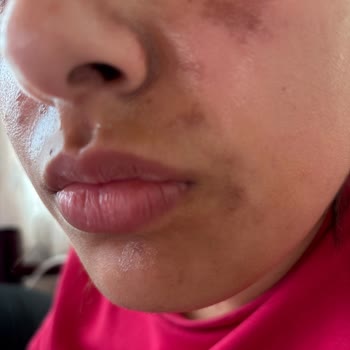 Ciltte Yanık Ve Kabarcıklar: Ürünün Tehlikeli Etkisi