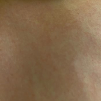 Bioderma Çatlak Yağı Kullanımı Sonrası Kaşıntı Ve Kızarıklık Sorunu