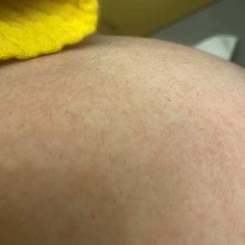 Bioderma Çatlak Yağı Kullanımı Sonrası Kaşıntı Ve Kızarıklık Sorunu