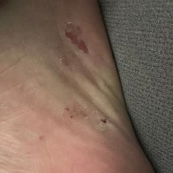 Skechers Ayakkabılar Ayağımı Yaraladı