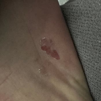 Skechers Ayakkabılar Ayağımı Yaraladı