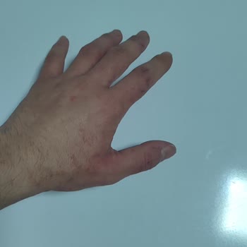 Sağlık Bakanlığı Uyuz Şikayeti