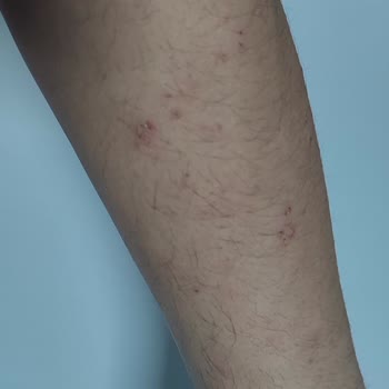 Sağlık Bakanlığı Uyuz Şikayeti