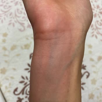 Bioderma Kremi İle Yaşadığım Cilt Reaksiyonu