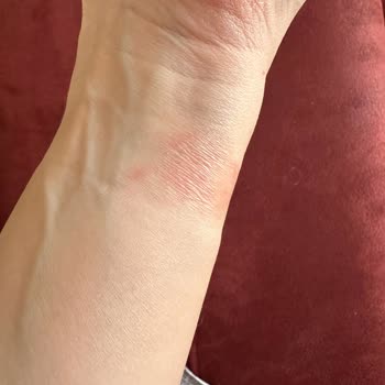 Watch 10 Kayışı Egzama Yaptı: Acil Çözüm Bekliyorum