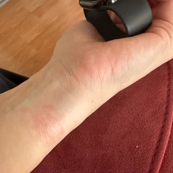 Watch 10 Kayışı Egzama Yaptı: Acil Çözüm Bekliyorum