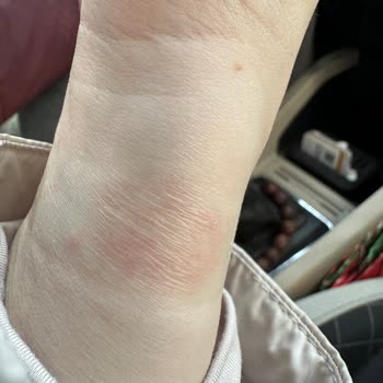 Watch 10 Kayışı Egzama Yaptı: Acil Çözüm Bekliyorum