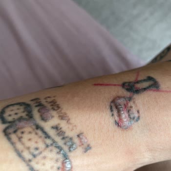 Dövme Sildirme Yanıkları: Beklenmedik Sonuçlar