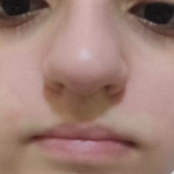 Isana Aktiv Kohle Yüz Maskesi Alerjik Reaksiyon Yarattı