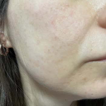 Cilt Bakım Ürünleri Kullanımı Sonrası Egzama Şikayeti