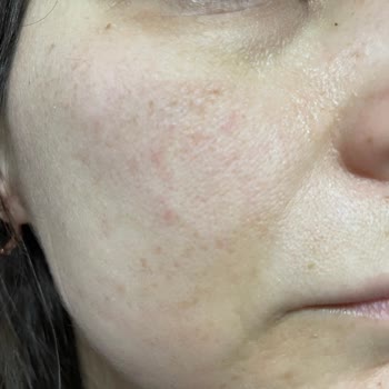 Cilt Bakım Ürünleri Kullanımı Sonrası Egzama Şikayeti