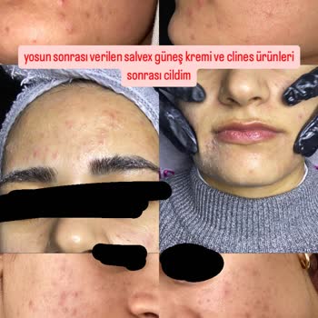 Yosun Peelingi Sonrası Cilt Sorunları Ve İlgisiz Hizmet