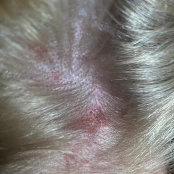 Palette Saç Açıcı Alerjik Reaksiyona Sebep Oldu