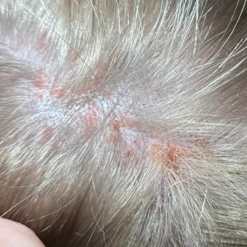 Palette Saç Açıcı Alerjik Reaksiyona Sebep Oldu