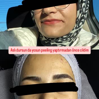 Yanlış Ürün Tavsiyesi Ve Yetersiz Hizmet Nedeniyle Cilt Sorunları