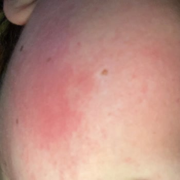 Alerjik Reaksiyon Ve Hayal Kırıklığı