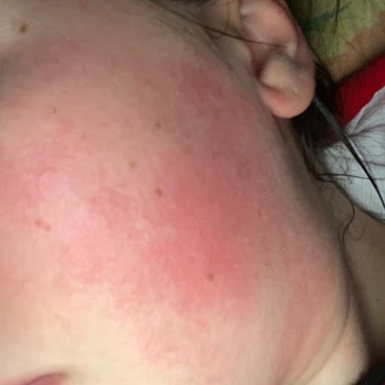 Alerjik Reaksiyon Ve Hayal Kırıklığı