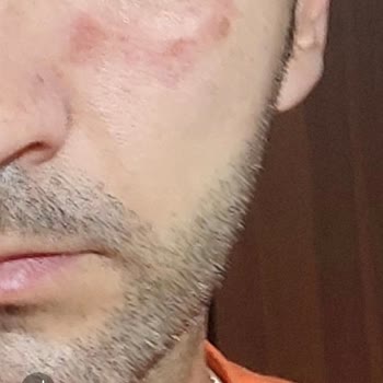 Lazer Tedavisi Sonrası Beklenmedik Yan Etkiler