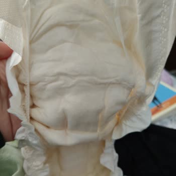 Bebek Bezi Kabusu: Alerji Ve Sızdırma Sorunları