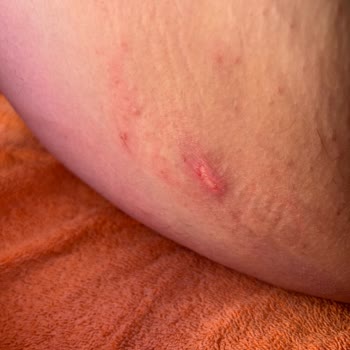 Penti Korse Yüzünden Yaşadığım Yanık Sorunu