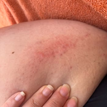 Penti Korse Yüzünden Yaşadığım Yanık Sorunu