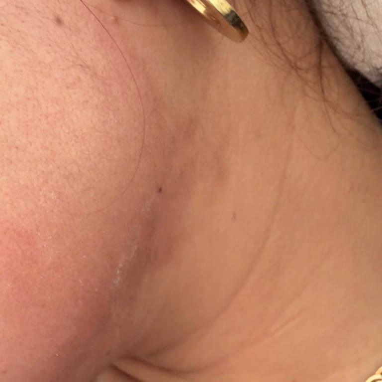 Güzellik Merkezinde Yanık Ve İlgisizlik Mağduriyeti