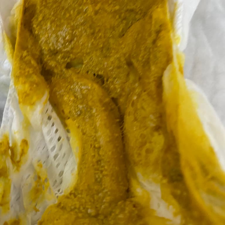 Aptamil AR Kullanımı Sonrası Bebekte İshal Problemi